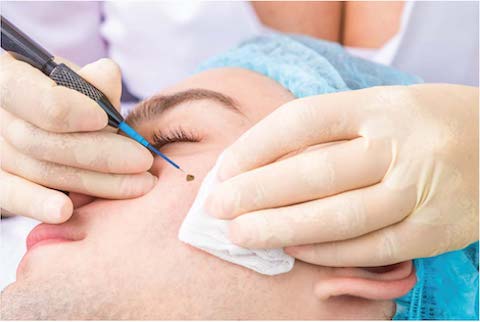 electro cautery