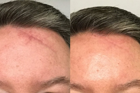 face / body scar revision